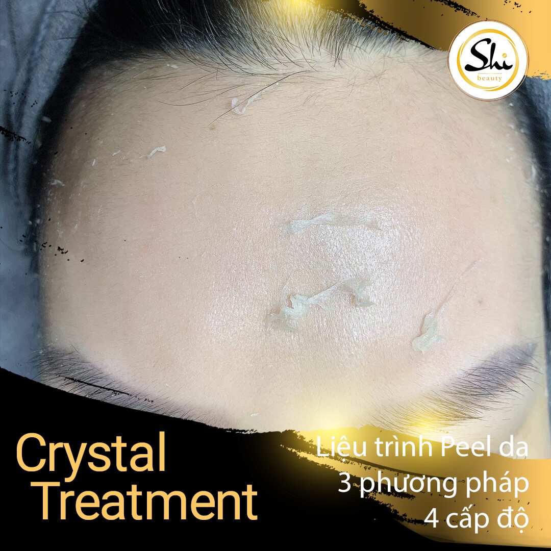 Crystal Facial Treatment - Liệu trình Peel da 3 phương pháp & 4 cấp độ
