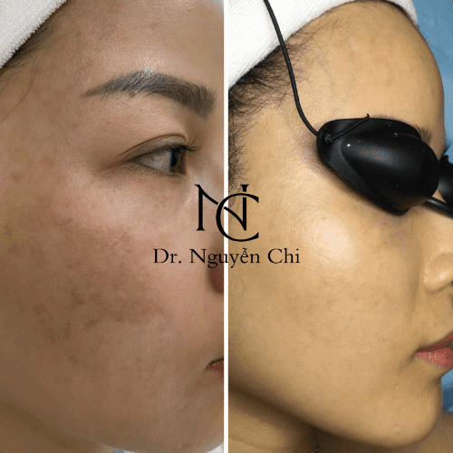FEEDBACK KHÁCH HÀNG ĐIỀU TRỊ NÁM THÀNH CÔNG
