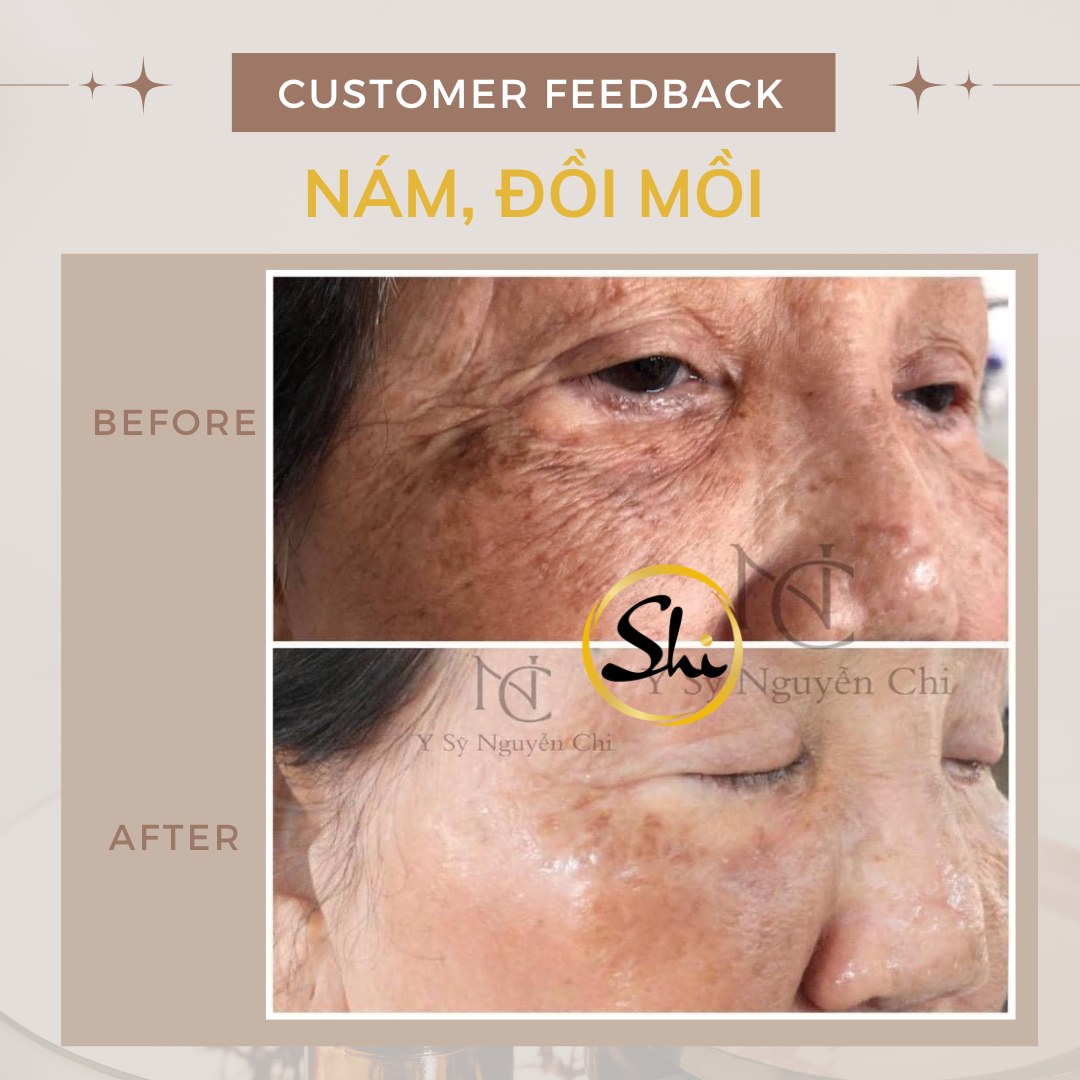 Em ơi, bây giờ chị mới điều trị nám thì liệu có muộn không?