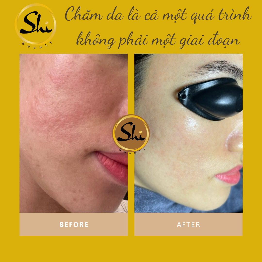 Tạm biệt giãn mao mạch